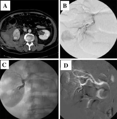 經皮腎鏡取石術的併發症 經皮腎鏡取石術的併發症