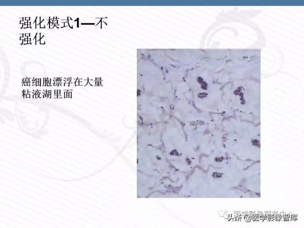 乳腺T2WI高訊號腫瘤病變的診斷思路 乳腺T2WI高訊號腫瘤病變的診斷思路