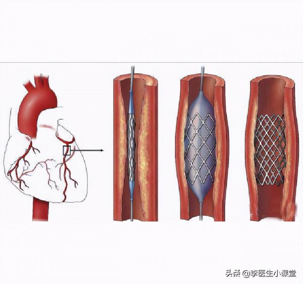 闢謠！冠心病好轉後就不用吃藥了嗎？有多少人因此放了心臟支架