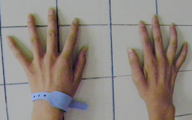 手部無力,上肢萎縮,手掌呈爪狀?醫生提醒:警惕“平山病” 手部無力,上肢萎縮,手掌呈爪狀?醫生提醒:警惕“平山病”