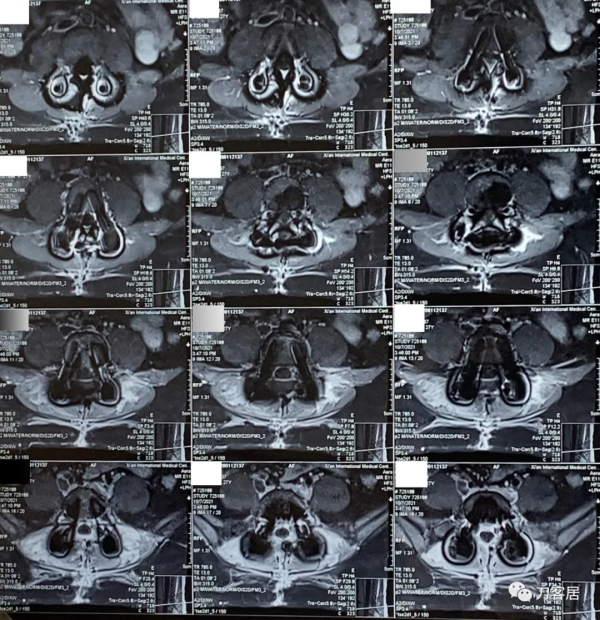 27歲女性，兩間隙腰椎間盤突出症，6顆釘子，4個融合器