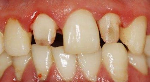 牙齒畸形，只知道“地包天”？各種畸形一文講清