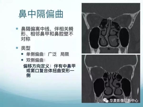 頭頸五官CT斷層解剖圖及常見病影像診斷