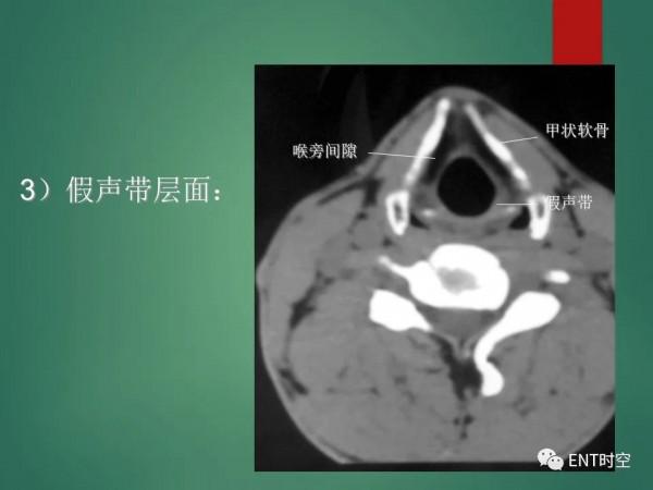 頭頸五官CT斷層解剖圖及常見病影像診斷