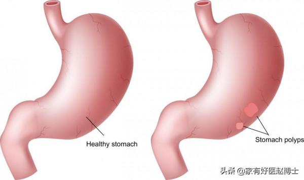 最常見5類息肉每個人都可能有，哪些無癌變風險，哪些需要切除？