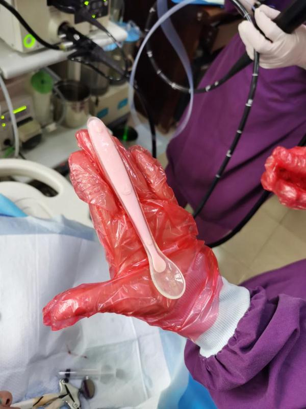 足足17釐米！感覺喉嚨有異物，女子竟將勺子整個吞下肚