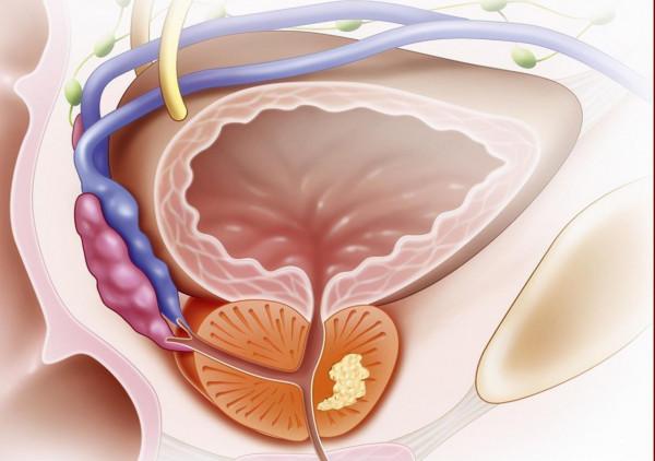 全世界每年有1.5億這種病例,而且女性發病率是男性的10倍 全世界每年有1.5億這種病例,而且女性發病率是男性的10倍