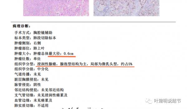 指南說小於5毫米的肺結節不需要隨訪，打臉來了