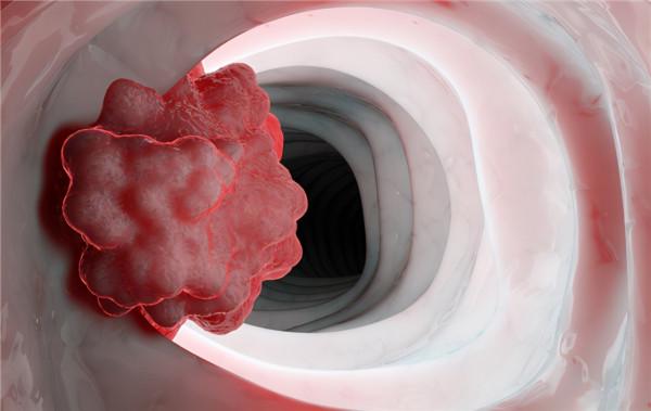 經常放屁是身體得腸癌的提示嗎? 經常放屁是身體得腸癌的提示嗎?