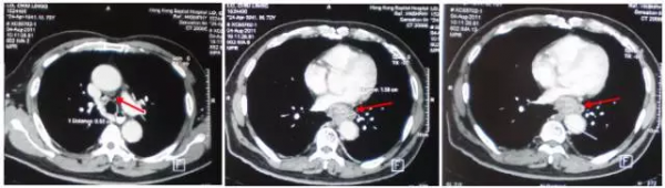 經典病例分享 | 多學科綜合治療區域性晚期食管癌完全緩解一例