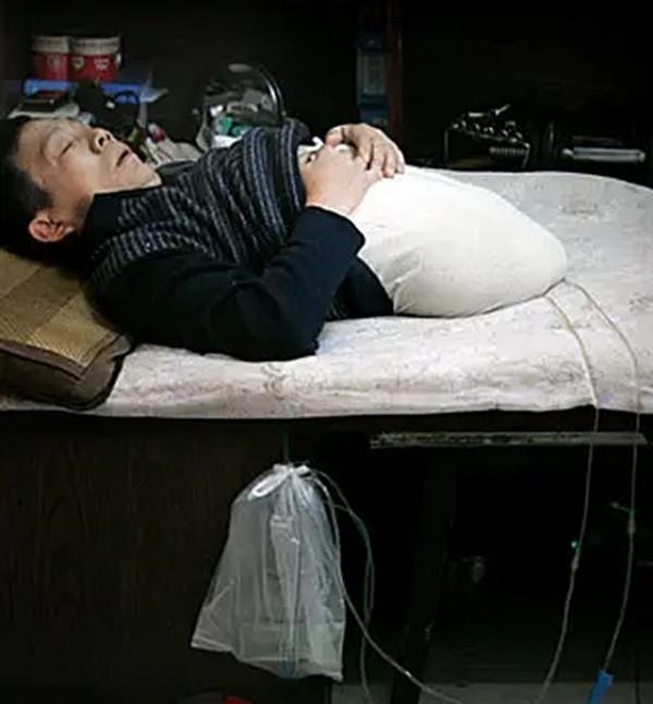 04年彭水林因車禍被“削”為78釐米，妻子不離不棄，今小孫女在手