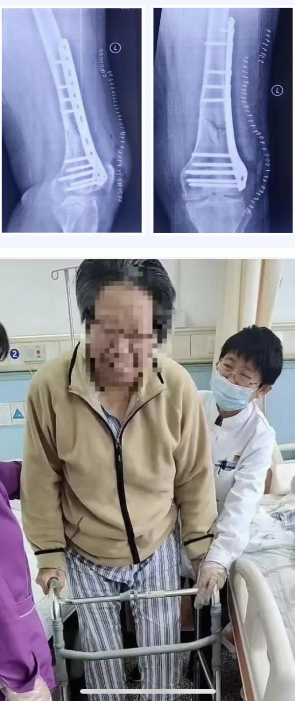 全國首例！3D列印定製鋼板助70歲患者重建股骨遠端