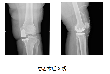 人工智慧+新型單髁關節 “黑科技”搭配“新材料”助哈醫大一院骨科專家一天治癒五年老腿疼 人工智慧+新型單髁關節 “黑科技”搭配“新材料”助哈醫大一院骨科專家一天治癒五年老腿疼