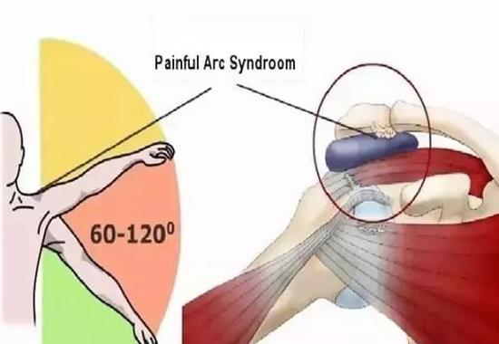 肩關節功能障礙的幾個常見原因
