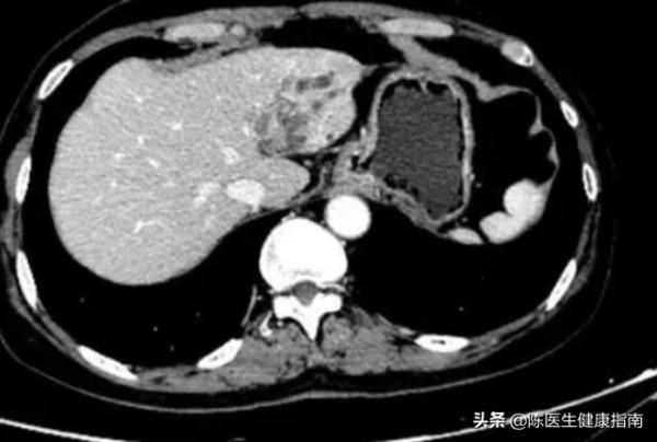 乙肝患者，服用恩替卡韋就不能停了？長期服用會怎麼樣？