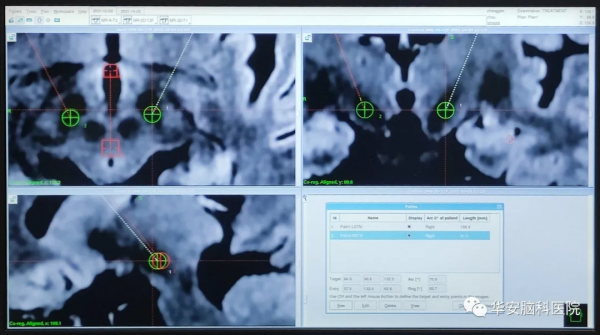 「跨省求醫」華安腦科醫院成功開展首例DBS手術治療梅傑綜合徵