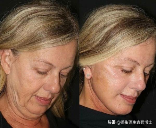 別拿寶貴的臉去“試錯”,醫美專案得這麼選(醫生經驗總結) 別拿寶貴的臉去“試錯”,醫美專案得這麼選(醫生經驗總結)