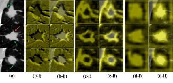 科研人員實現早期肺癌淋巴結轉移精準無創診斷 科研人員實現早期肺癌淋巴結轉移精準無創診斷