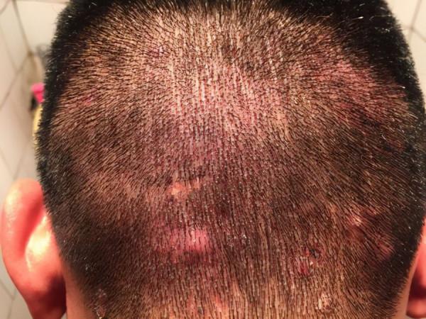 頭上總是長疙瘩，還時不時有膿包？很可能是這4種現象引起的