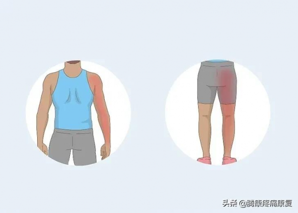 是肌肉勞損還是椎間盤突出，關於背疼你需要知道這些