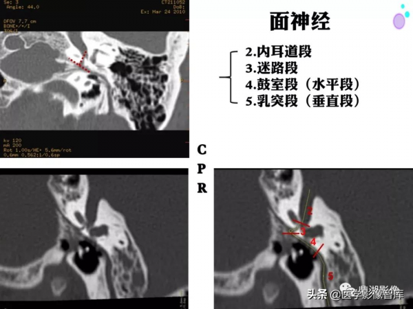 CT斷層解剖圖譜最全總結「推薦收藏」 CT斷層解剖圖譜最全總結「推薦收藏」