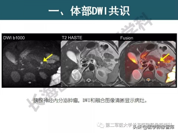 體部DWI共識及胰腺DWI研究經驗介紹