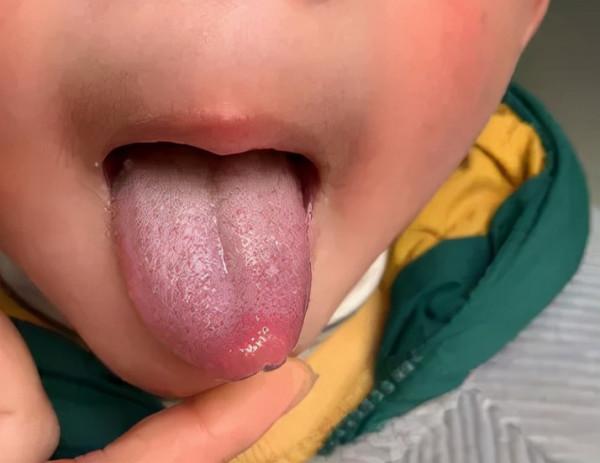 小兒體溫居高不下,可能是食積作祟,中醫消食導滯法,療效顯著 小兒體溫居高不下,可能是食積作祟,中醫消食導滯法,療效顯著