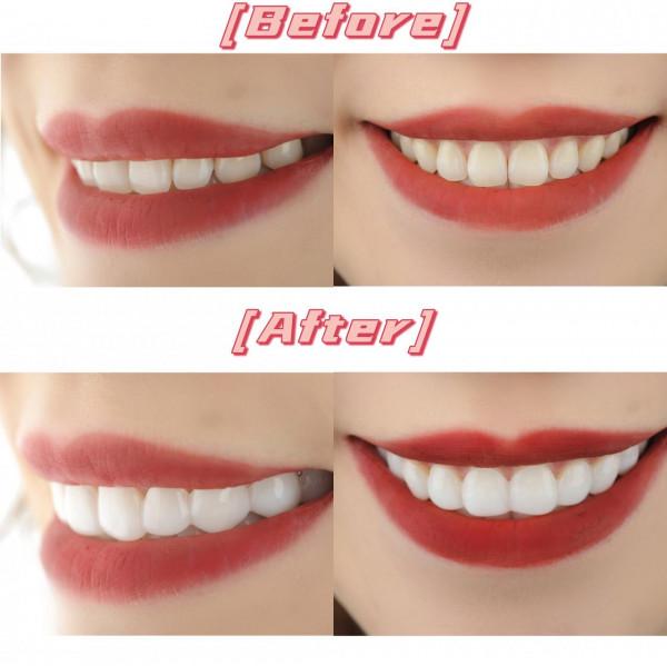 白色保持器,保持正畸效果+亮白牙齒,收穫雙重喜悅 白色保持器,保持正畸效果+亮白牙齒,收穫雙重喜悅