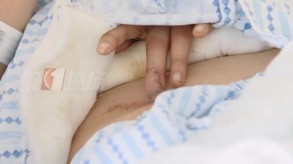 要煲湯一刀剁下半個手指！醫生救人出奇招：把手指“種”在肚皮上
