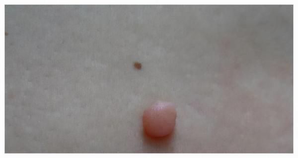 醫生眼裡常見的6種&OpenCurlyDoubleQuote;瘤&rdquo;，確診後千萬別害怕，惡化的機率很小