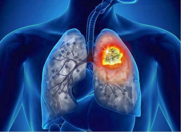 紫茄子會“加劇”肺結節嗎？醫生：若想肺好，四種食物還請少碰