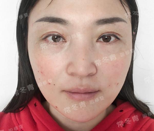 雙眼皮修復 | 常見的3種需要修復情況:寬假深、上瞼凹陷,不對稱 雙眼皮修復 | 常見的3種需要修復情況:寬假深、上瞼凹陷,不對稱