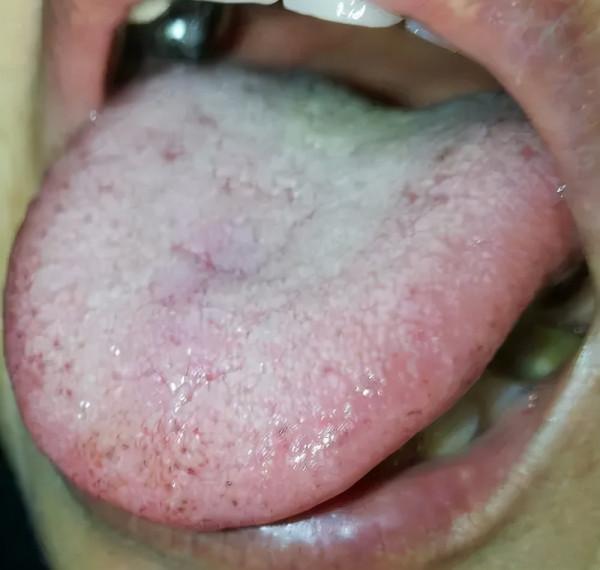 口腔舌頭燒灼疼痛是怎麼回事? 口腔舌頭燒灼疼痛是怎麼回事?