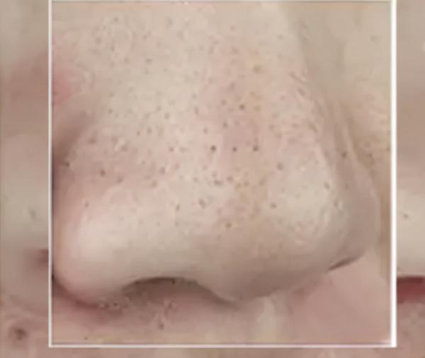 你鼻子上的真的是黑頭嗎？教你正確祛黑頭