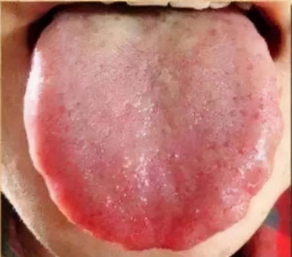 舌頭邊緣有齒痕，舌苔中間有裂紋？3種齒痕5種裂紋，你是哪一種？