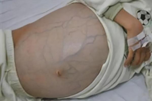 肝癌腹水難消,只能反覆抽腹水?老中醫經驗分享,應對頑固腹水 肝癌腹水難消,只能反覆抽腹水?老中醫經驗分享,應對頑固腹水