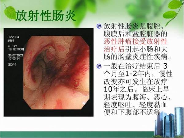 連續放療導致肚子“失控”，64歲患者選擇中藥治療，提高生存質量