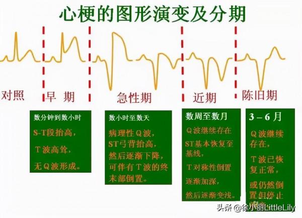 這樣教你看心電圖,沒有理由看不懂 這樣教你看心電圖,沒有理由看不懂
