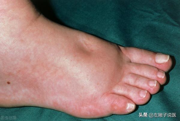 下肢出現水腫，是水喝多了還是腎臟出現問題了？本文告訴您真相