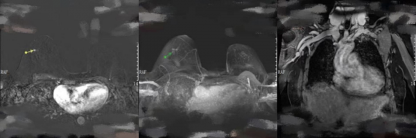 愈見未萊 | 赫帕雙靶新輔助治療HER-2+可手術乳腺癌患者，療效和安全性兼可得
