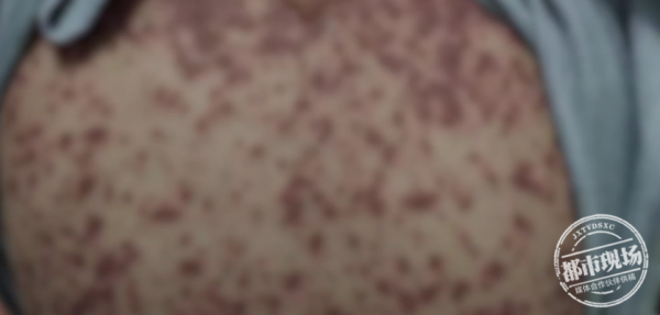 13歲女孩吃藥後,竟然全身潰爛、體無完膚!醫生緊急提醒 13歲女孩吃藥後,竟然全身潰爛、體無完膚!醫生緊急提醒