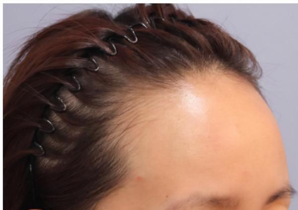 建議有“閉口”的女生，堅持做好這幾件事，高效解決不反覆