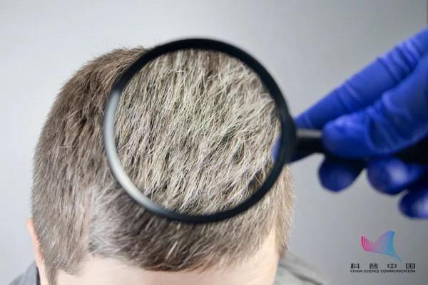 為什麼壓力大時會長白頭髮？這些情況要注意