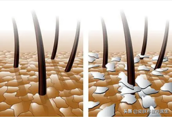 中醫治療脂溢性皮炎方法多，速看