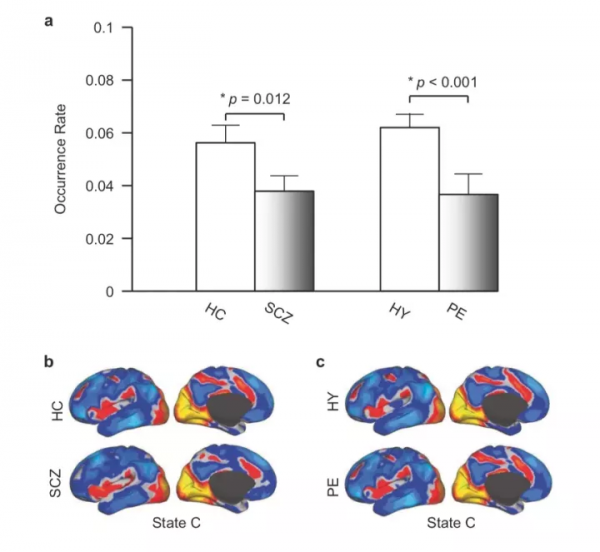 Nature子刊:劉河生教授發現精神疾病患者腦活動的核心紊亂z Nature子刊:劉河生教授發現精神疾病患者腦活動的核心紊亂z