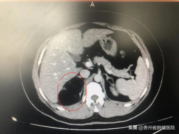 女子患上罕見腫瘤,泌尿外科醫生歷時3小時成功摘除 女子患上罕見腫瘤,泌尿外科醫生歷時3小時成功摘除