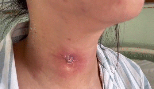 男子咽痛半年，醫生接二連三誤診，醫院：全院會診終找到病因