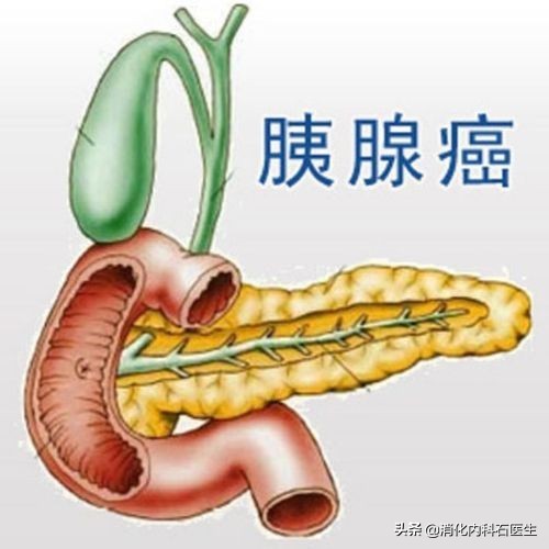女子腹痛、黃疸，以為結石開腹手術治療，開啟腹腔醫生直嘆氣