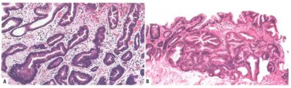 早期胃癌病理診斷：WHO VS.日本標準一文解析