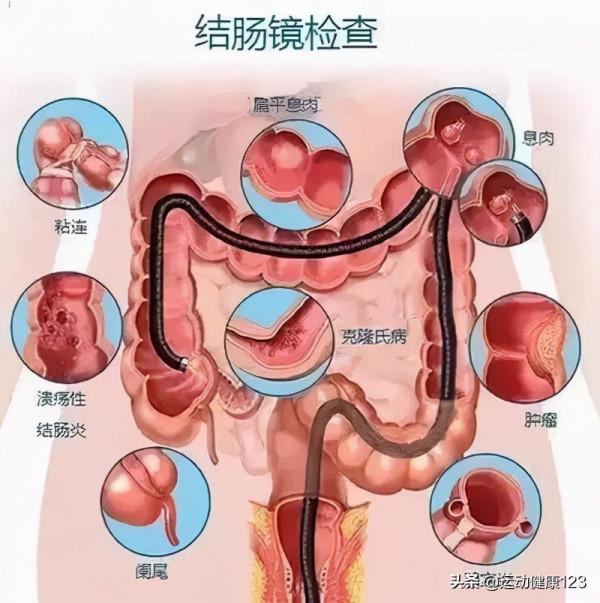惡性腫瘤早期發現之結直腸癌（大腸癌）